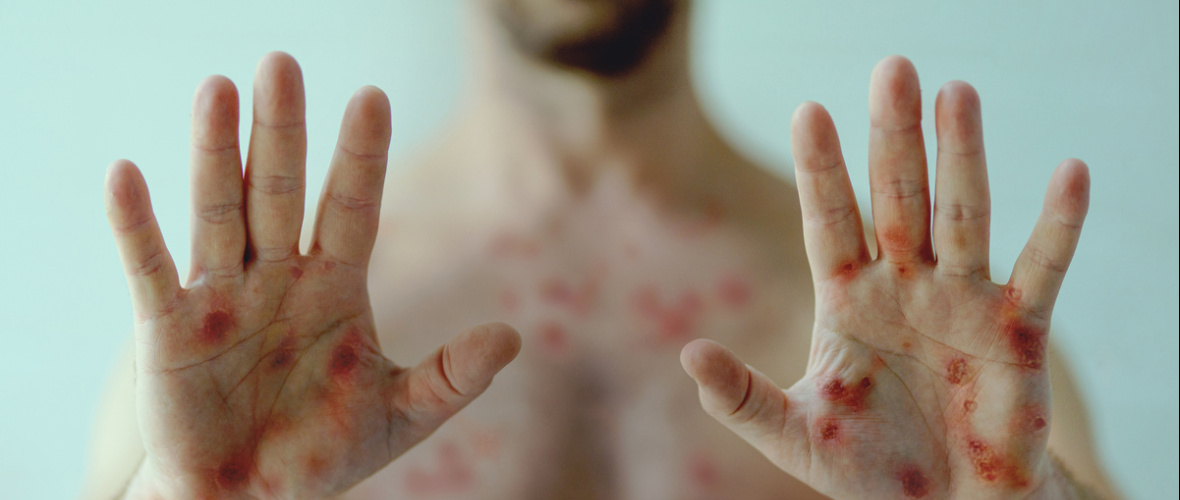 Sífilis en Argentina alcanzó récord histórico en 2025 con foco en Buenos Aires