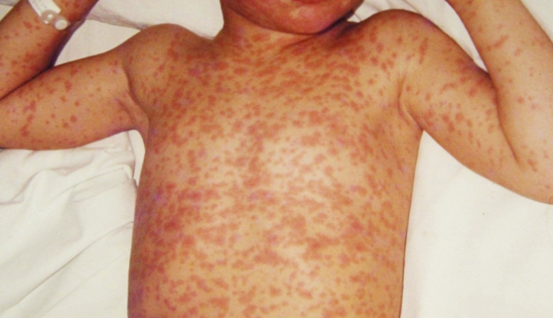 Sarampión: son 35 los contagios registrados y un brote en el sur del AMBA sigue activo