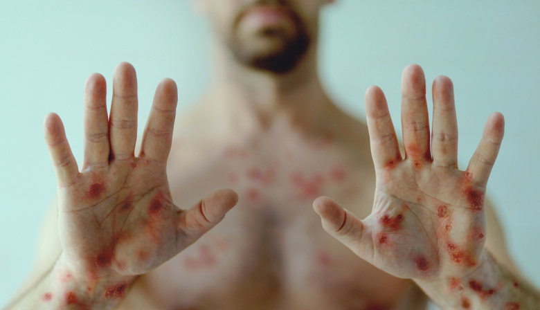 Sífilis en Argentina alcanzó récord histórico en 2025 con foco en Buenos Aires