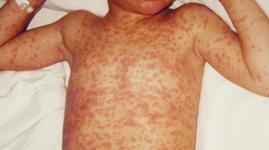 Sarampión: detectan dos casos más en el AMBA