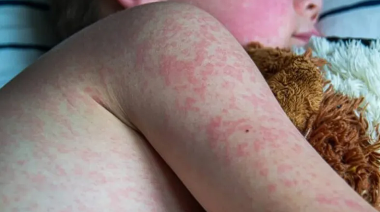 Sarampión: tras 12 semanas sin nuevos casos avanzan las acciones de "cierre" de los brotes registrados