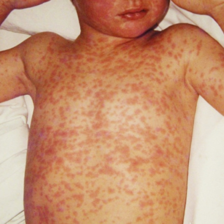 Sarampión: son 35 los contagios registrados y un brote en el sur del AMBA sigue activo