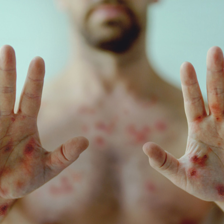 Sífilis en Argentina alcanzó récord histórico en 2025 con foco en Buenos Aires